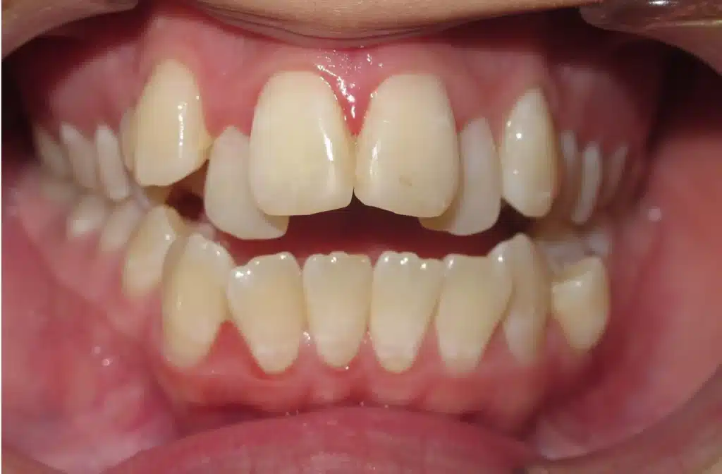 Anterior Open Bite can be caused by pacifier use