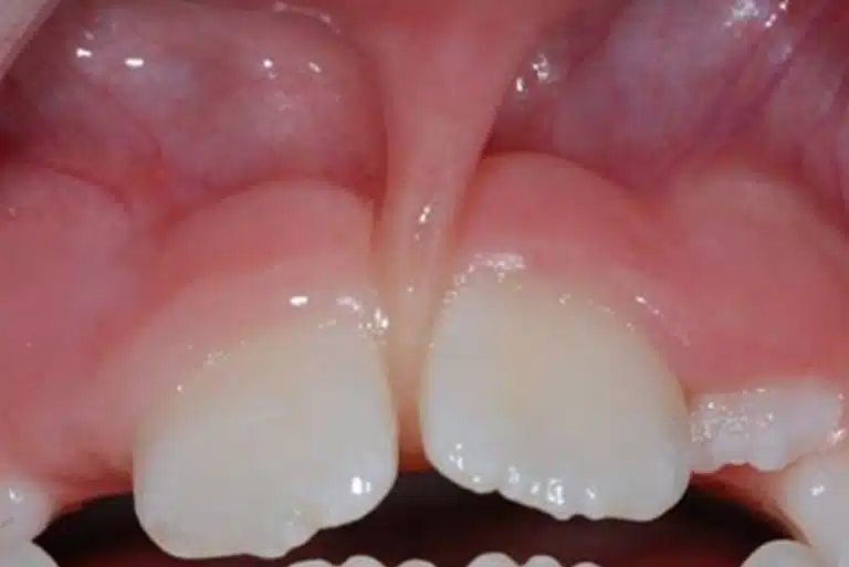 Lip and Tongue Tie Release