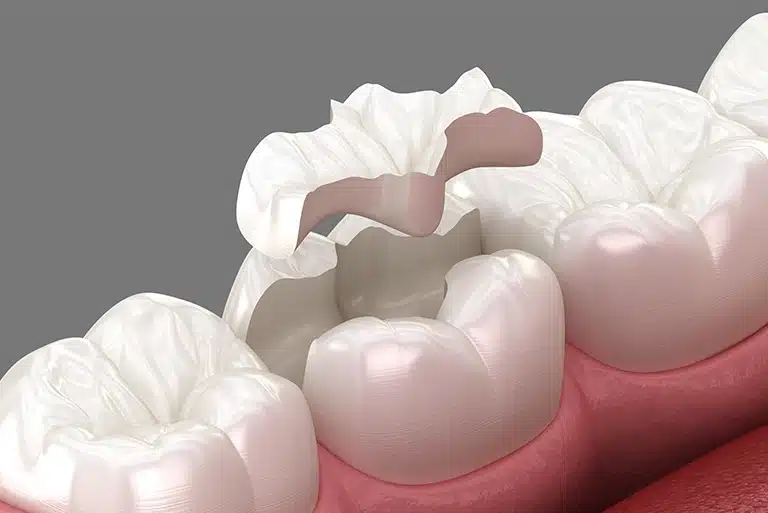Metal-Free Fillings - Inlay