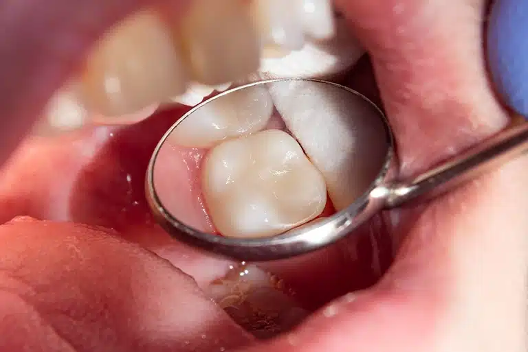 Metal Free Fillings and Crowns