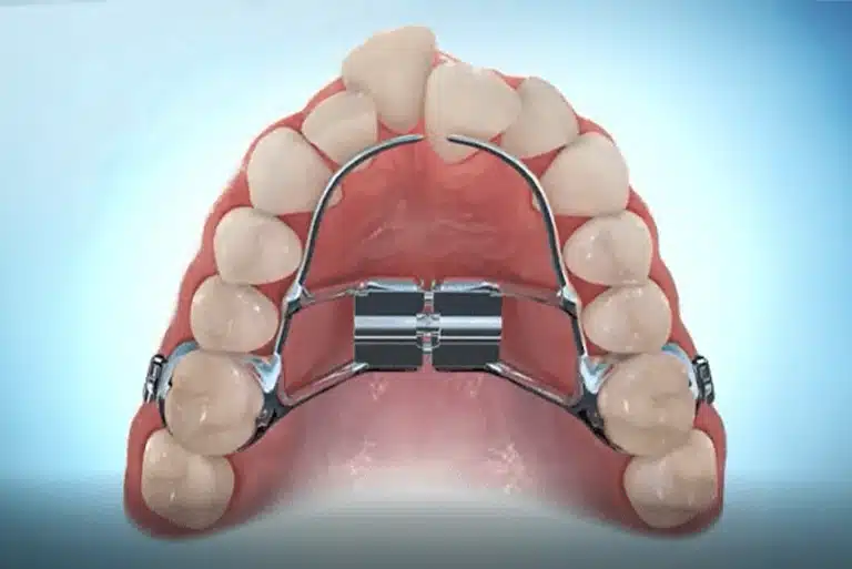 Palate expander