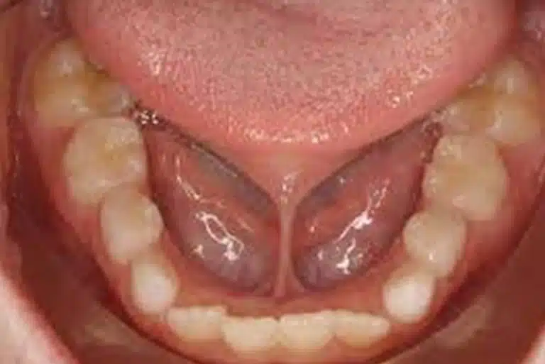 Tongue Tie Release