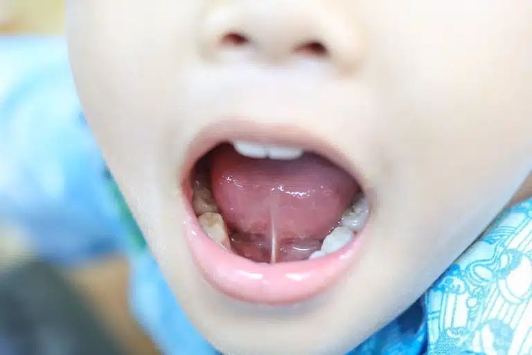 Tongue Tie Release