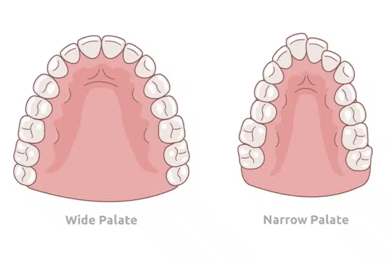narrow palate vs wide palate