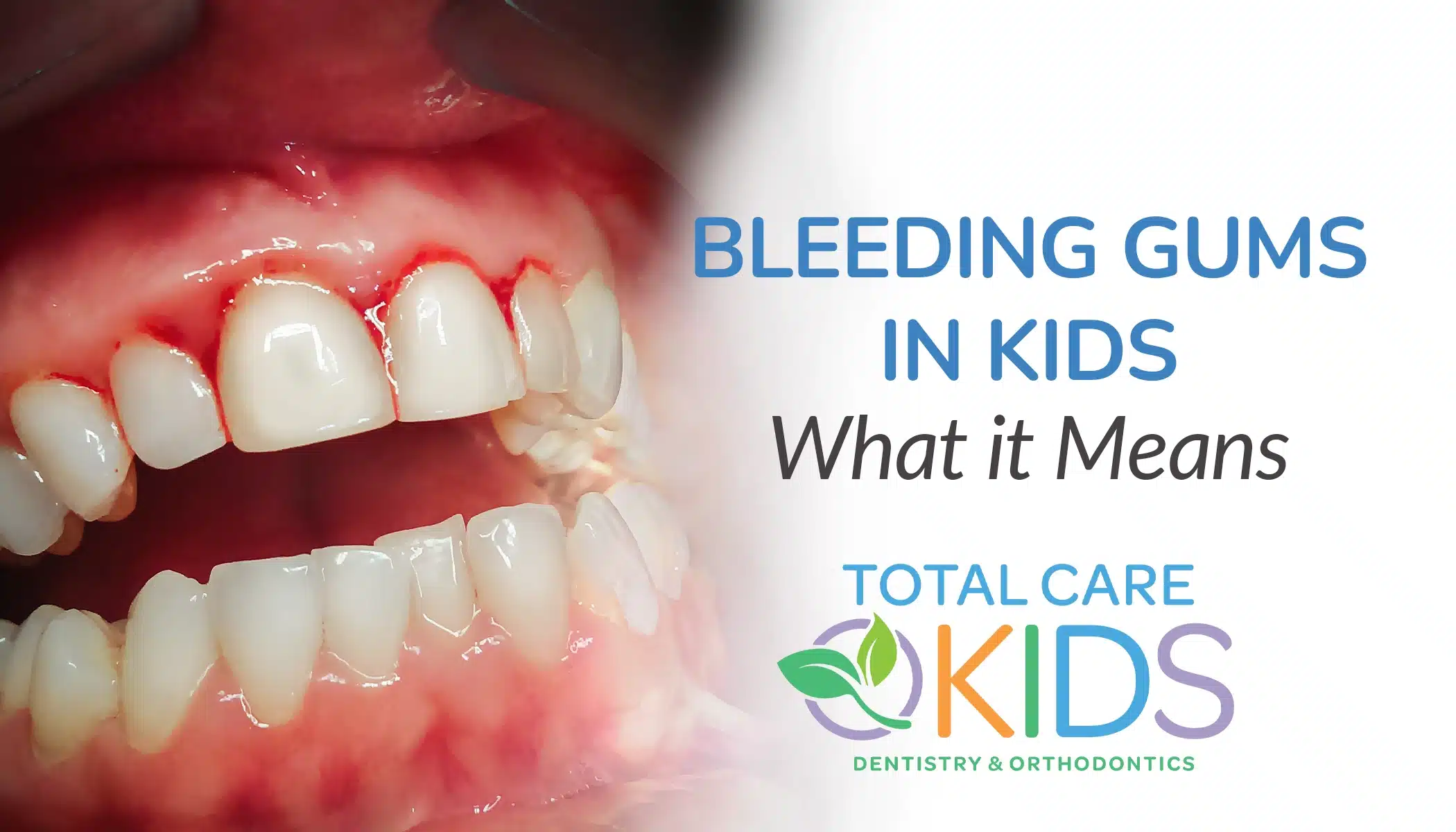 bleeding gums in kids website banner