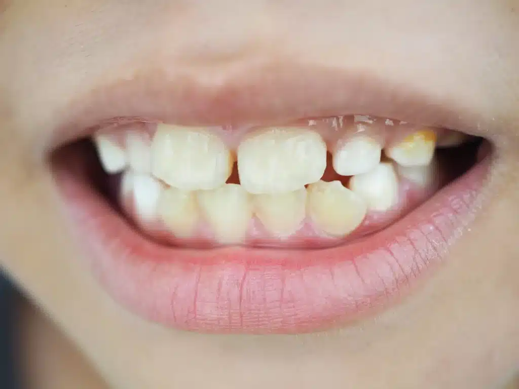 dental plaque and bleeding gums in kids