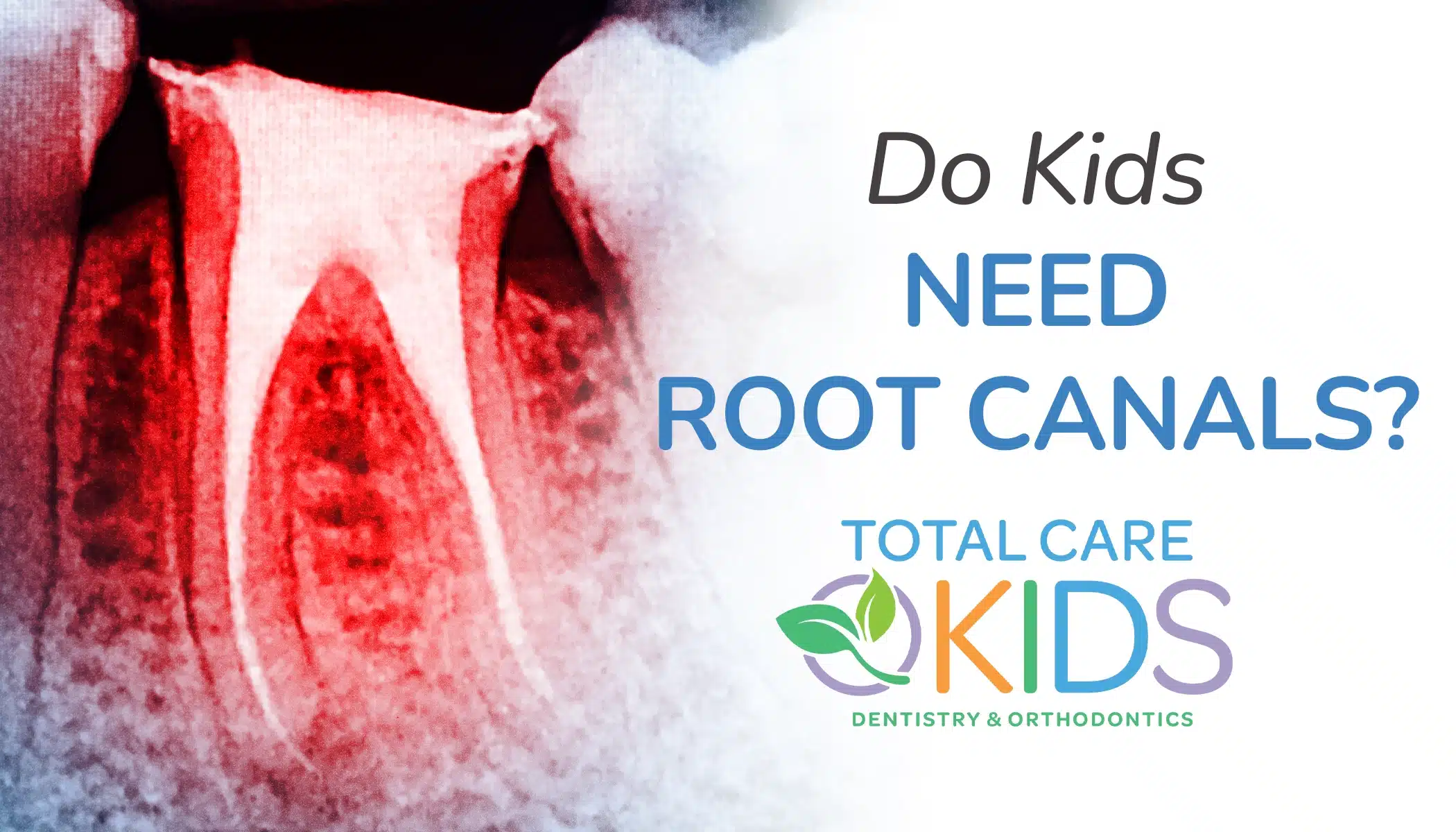 do kids need root canals